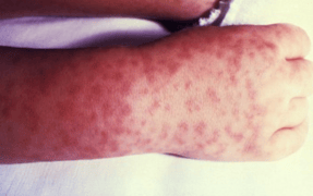 Rocky Mountain Spotted Fever Rash