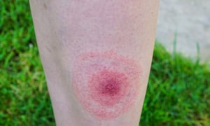 ESymptoms in acute Lyme disease