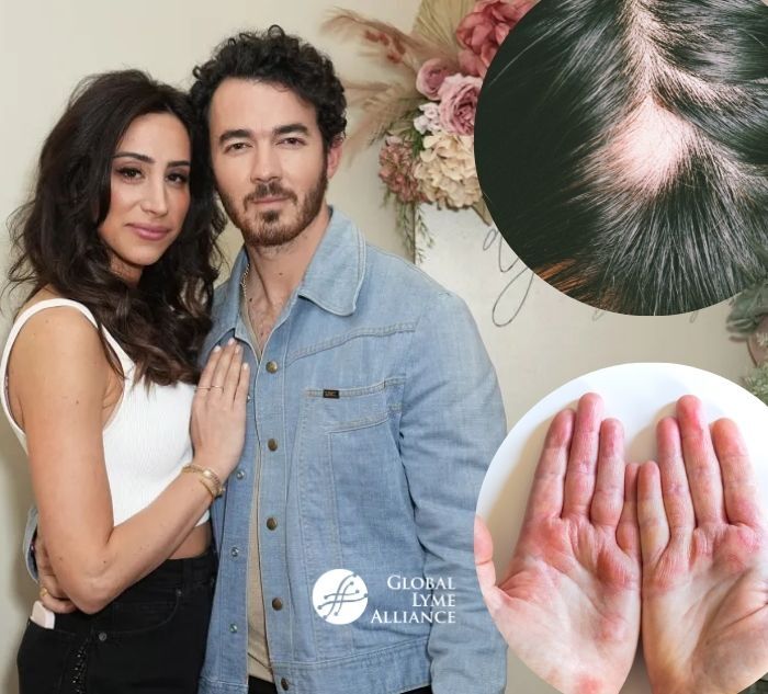 <span id="hs_cos_wrapper_name" class="hs_cos_wrapper hs_cos_wrapper_meta_field hs_cos_wrapper_type_text" style="" data-hs-cos-general-type="meta_field" data-hs-cos-type="text" >What We Can Learn from Danielle Jonas’ Lyme Disease Diagnosis</span>